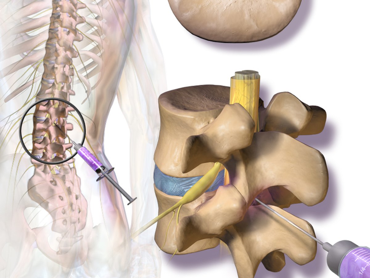 Illustration of an epidural steroid injection into the spine