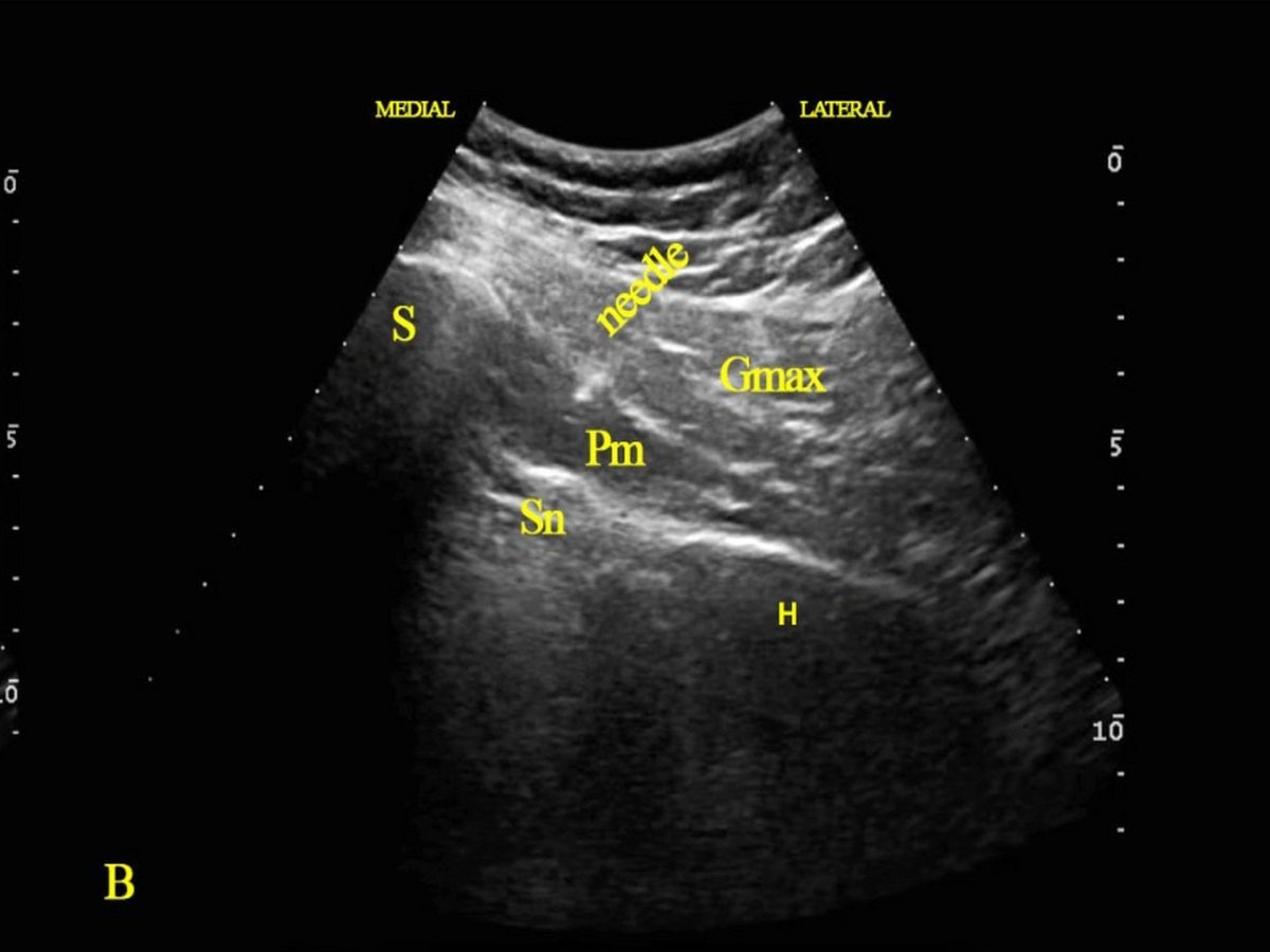 Ultrasound image showing a needle guided to a nerve