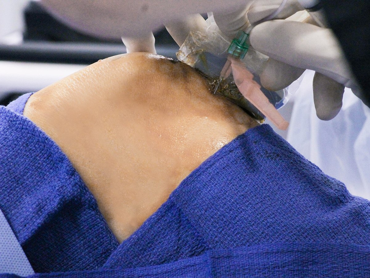 Injection into the knee joint