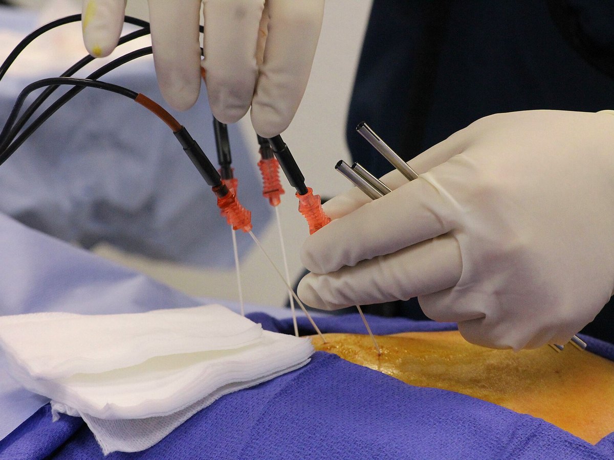 Radiofrequency probes placed along the spine during ablation