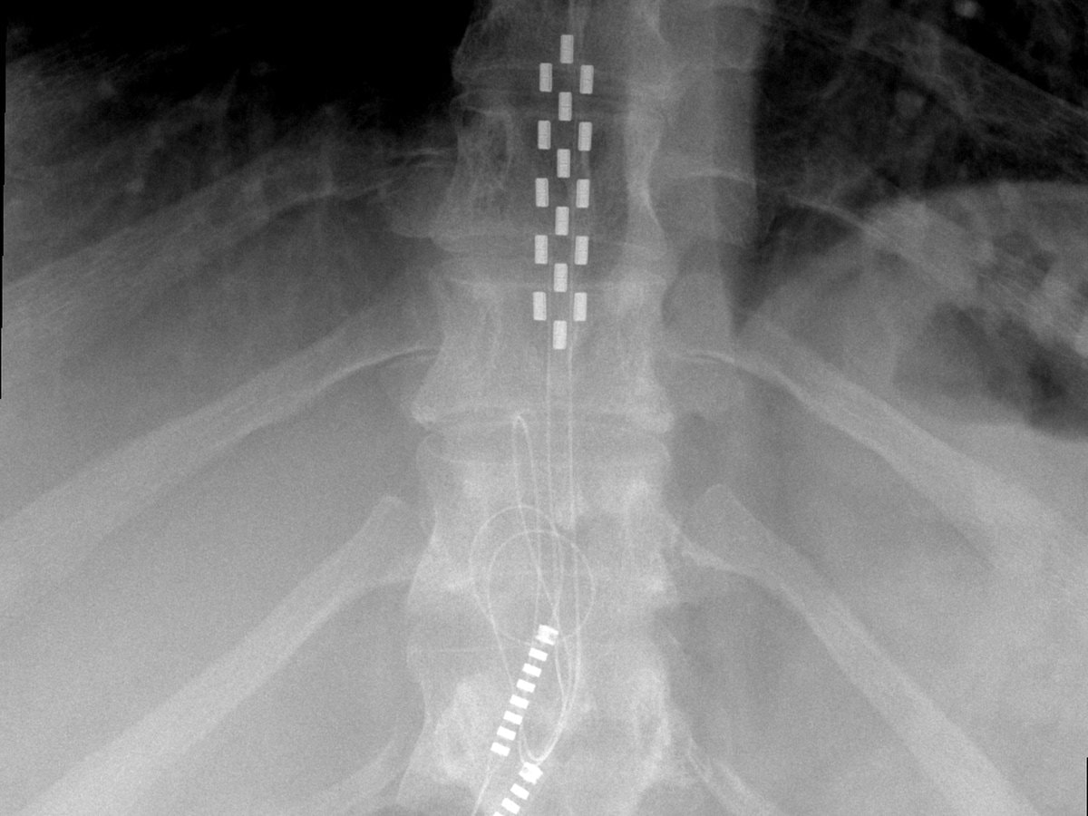 X-ray showing spinal cord stimulator leads along the spine